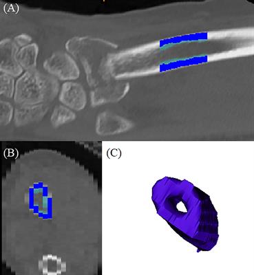 Growth differentiation factor-15 as a modulator of bone and muscle metabolism